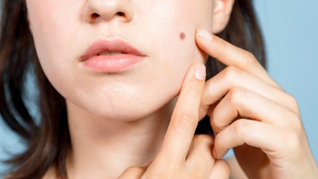 أسباب الزوائد الجلدية في الوجه