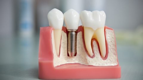 زراعة الأسنان بدون جراحة 2022