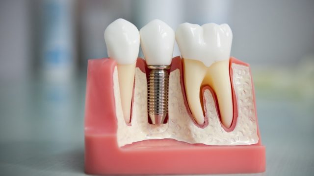زراعة الأسنان بدون جراحة 2023