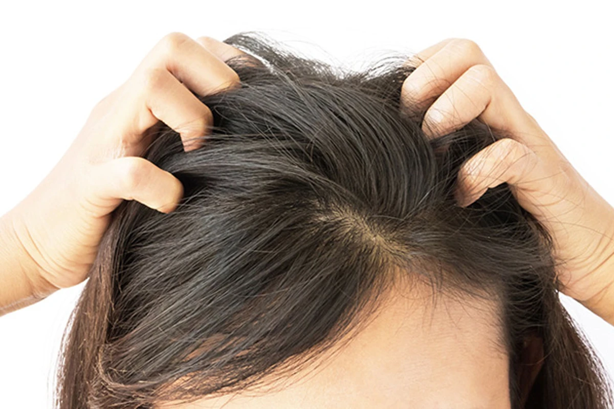 تجربتي في علاج صدفية الشعر في المنزل