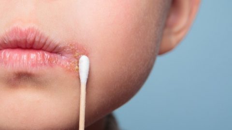 أسباب ظهور الحبوب حول الفم والذقن