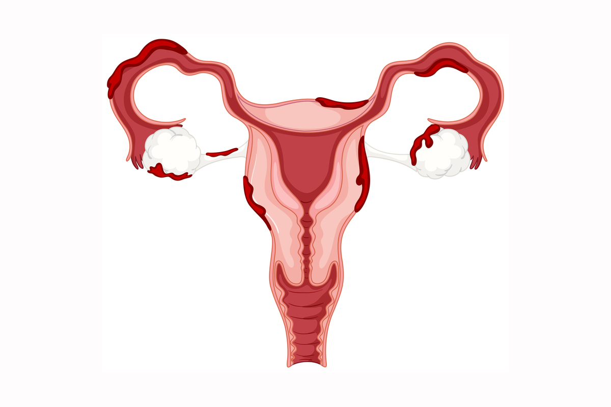 تجربتي مع تضخم الرحم