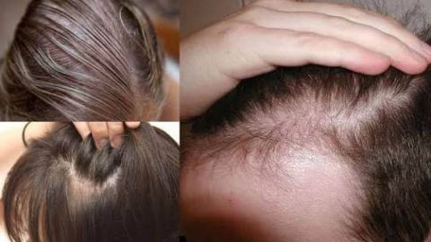تجربتي مع أفضل علاج لإنبات الشعر من الصيدلية