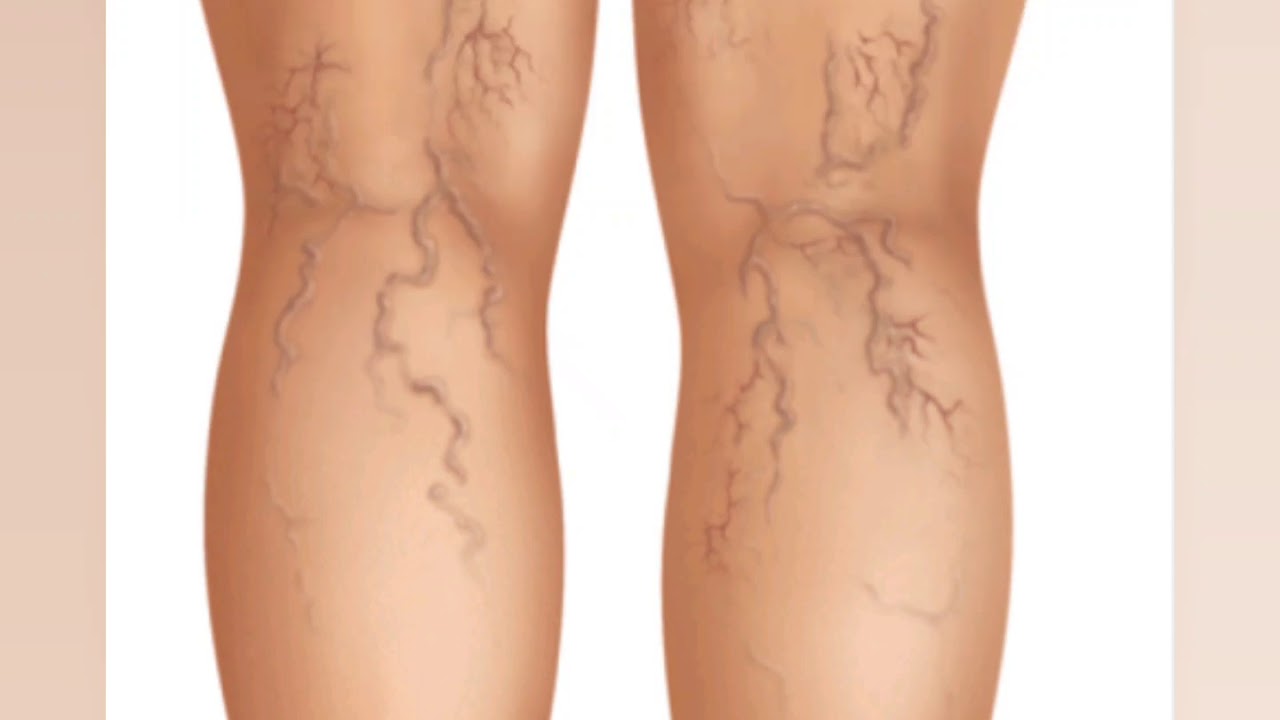 تجربتي مع الحجامة للدوالي وهل يمكن اختفاء الدوالي نهائيا ؟