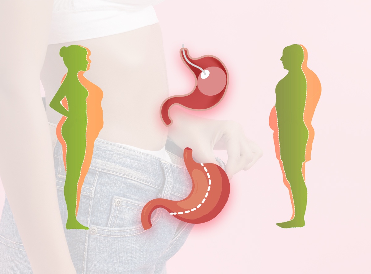 تجربتي مع الدكتور عايض القحطاني كرمشة المعدة والتكميم