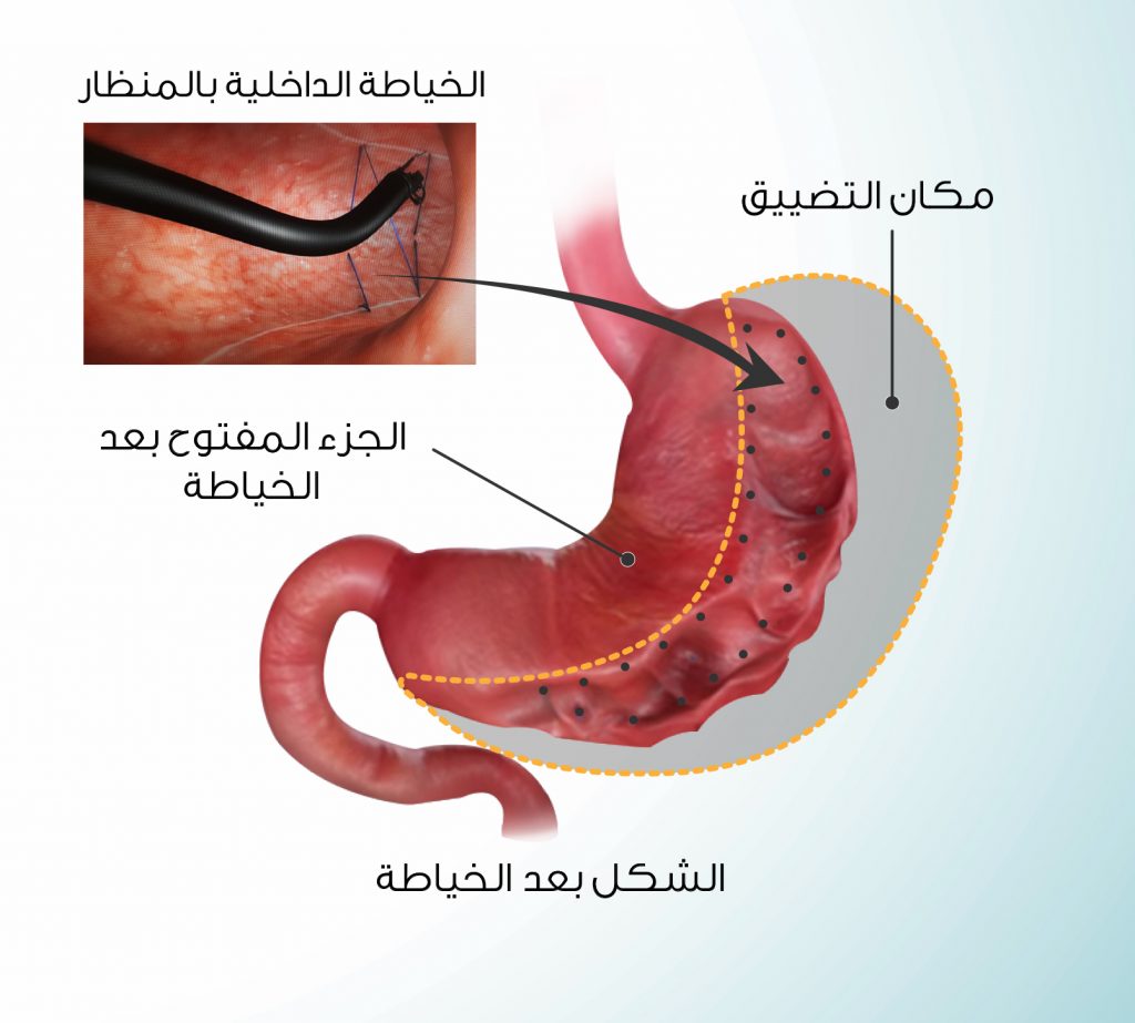 تجربتي مع الدكتور عايض القحطاني كرمشة المعدة والتكميم