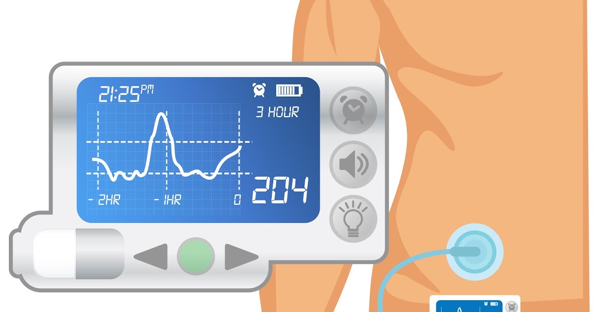 كم سعر مضخة الانسولين في السعودية ؟