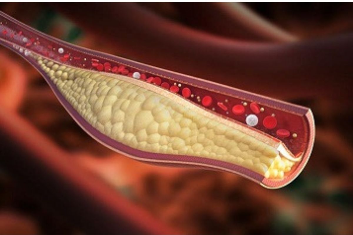 كيف انزل الكوليسترول بسرعة