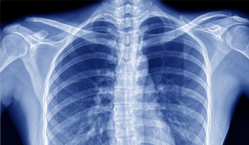 كيف تزيل الأشعة السينية جمال المرء وحسنه