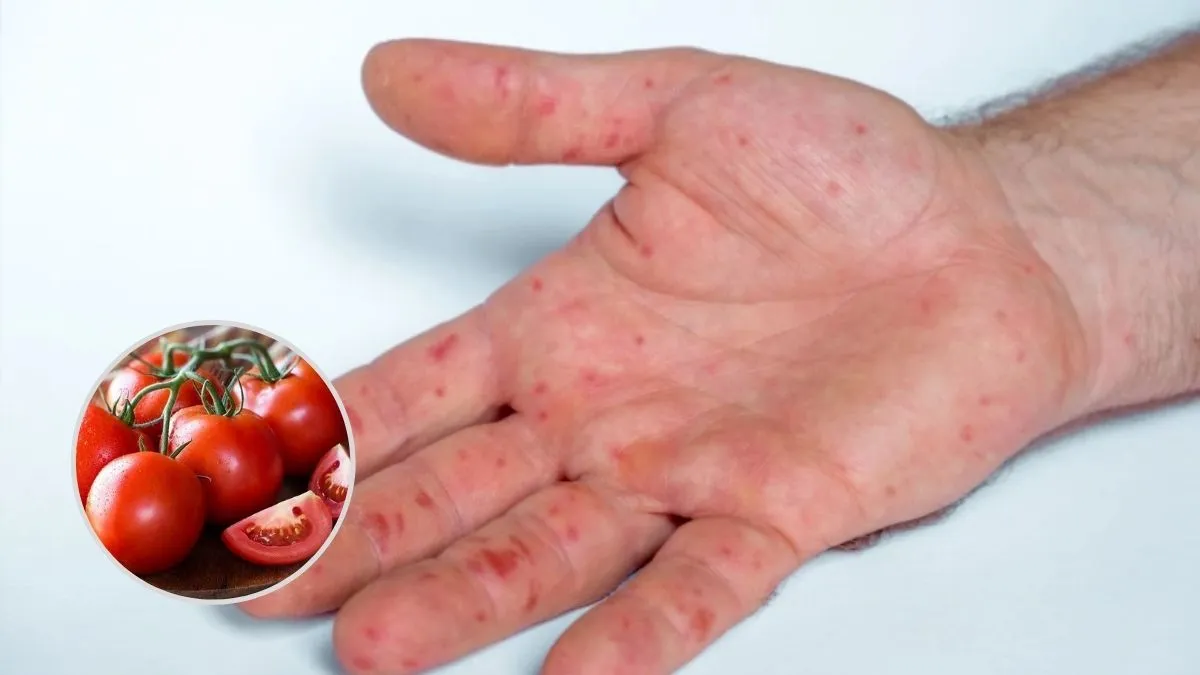 ما هي انفلونزا الطماطم ؟