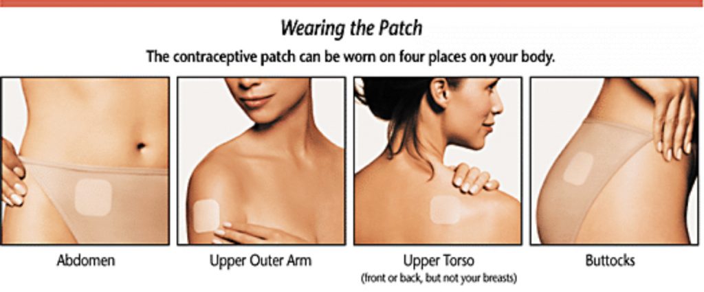 تجربتي مع لصاقات منع الحمل