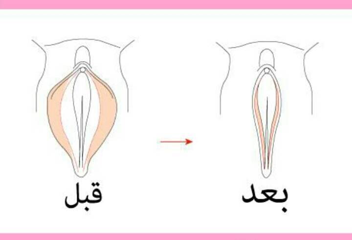 متى اسوي عملية تضييق المهبل بعد الولادة