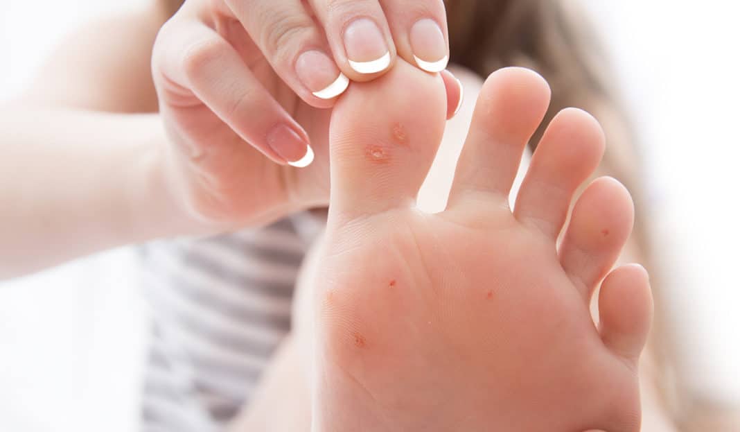علاج عين السمكة في الرجل