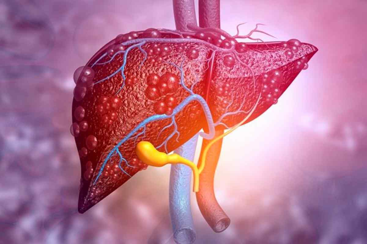 هل المرارة تسبب ارتفاع انزيمات الكبد