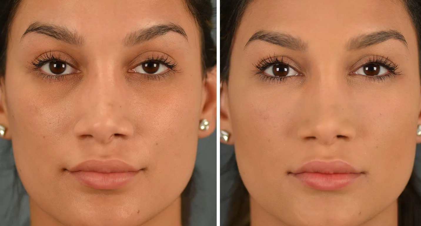 تجربتي مع الفيلر للهالات