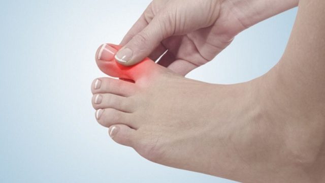 علاج تورم أصابع القدم بسبب الحذاء