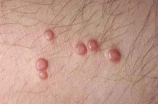 تجربتي مع المليساء المعدية