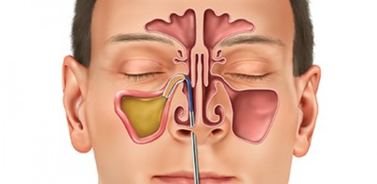 علاج انسداد الأنف بالاعشاب