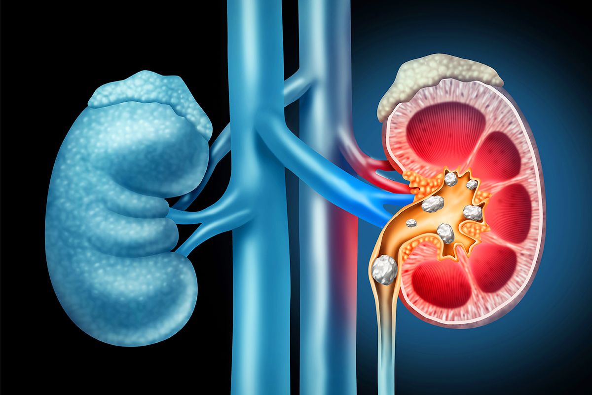 علامات تدل على وجود حصى الكلى