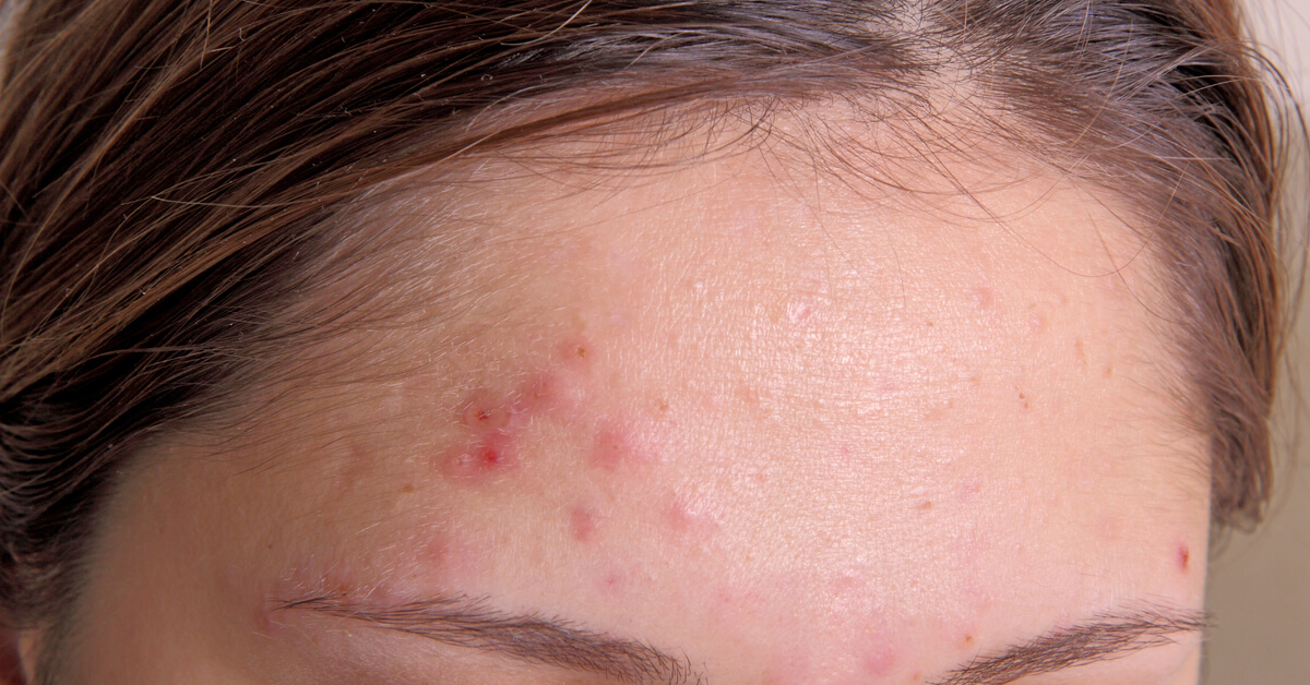 حبوب الجبهة على ماذا تدل