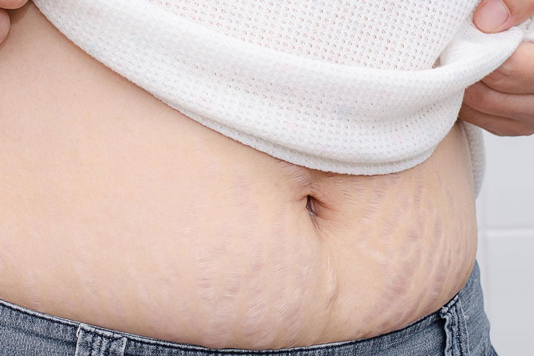 على ماذا تدل الخطوط البيضاء في الجسم