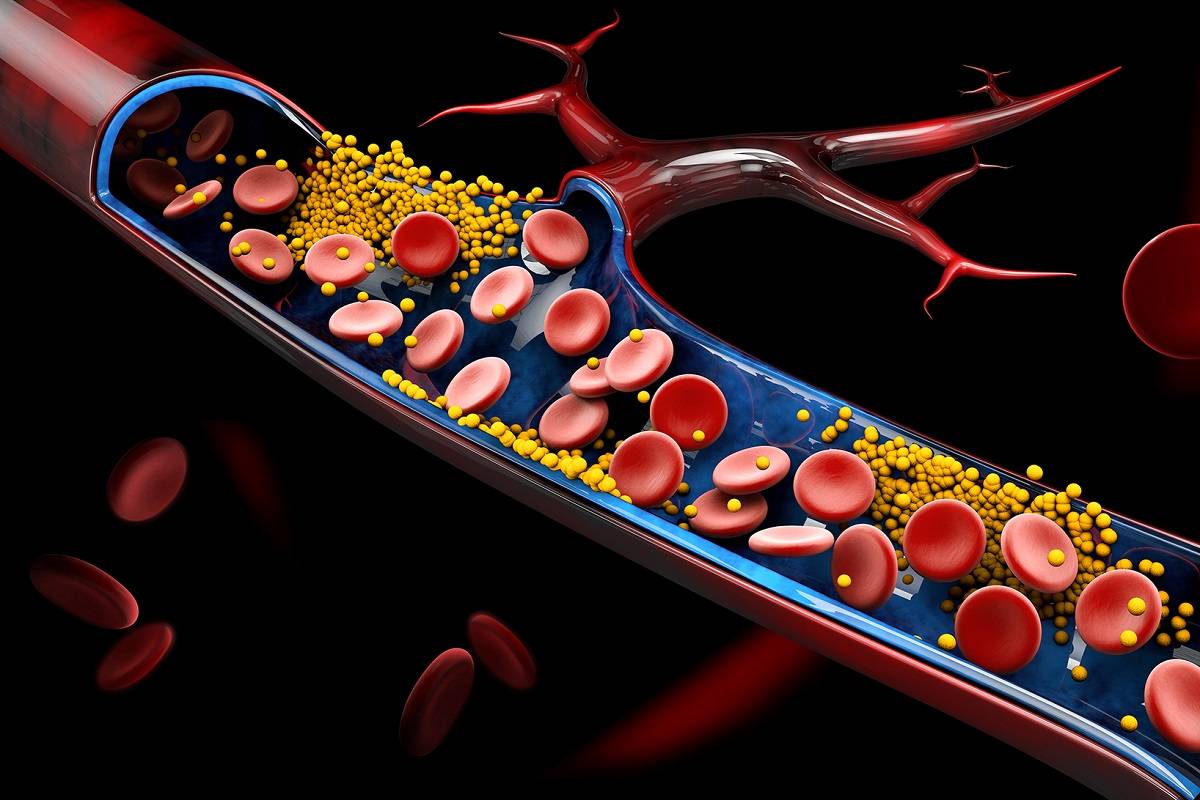 أعراض الكوليسترول الوراثي