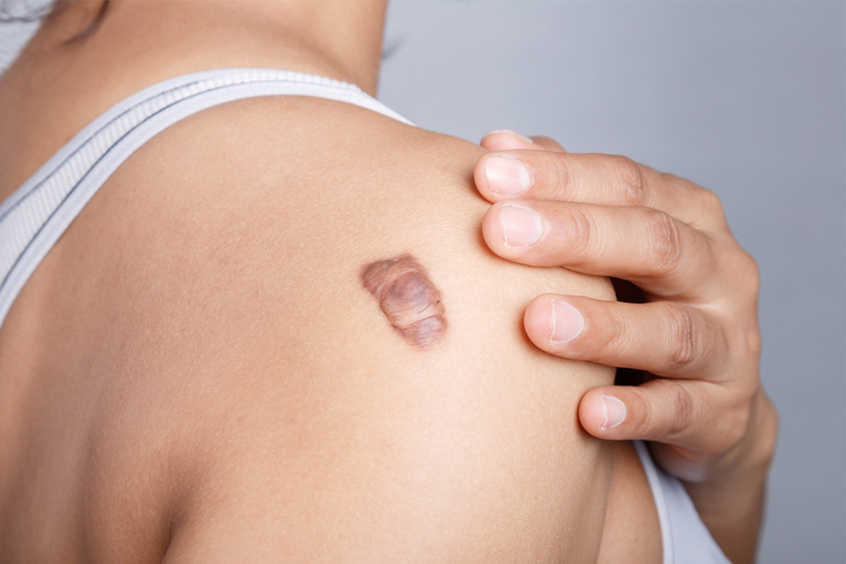 أعراض اللشمانيا الجلدية