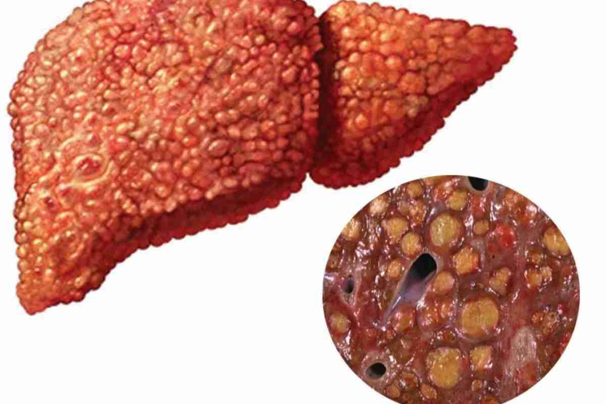 أعراض تليف الكبد المرحلة الرابعة