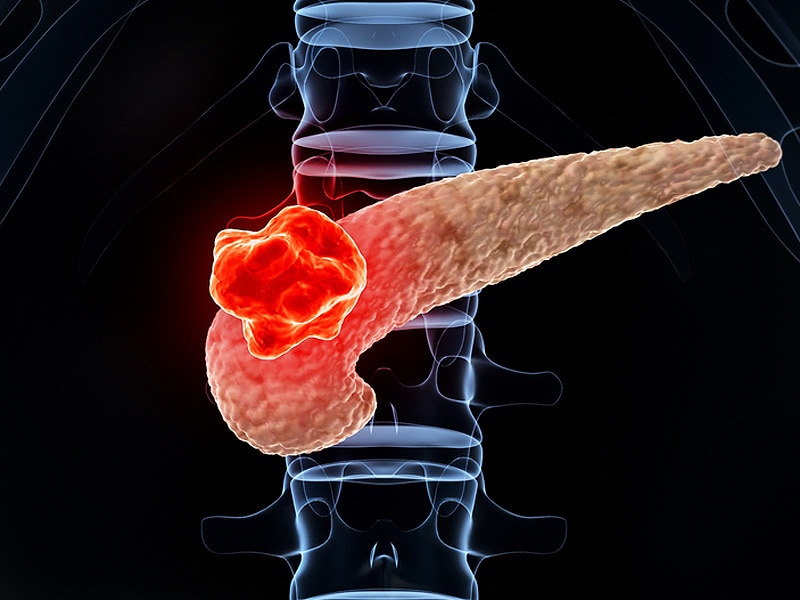 أعراض سرطان العظام النقيلي