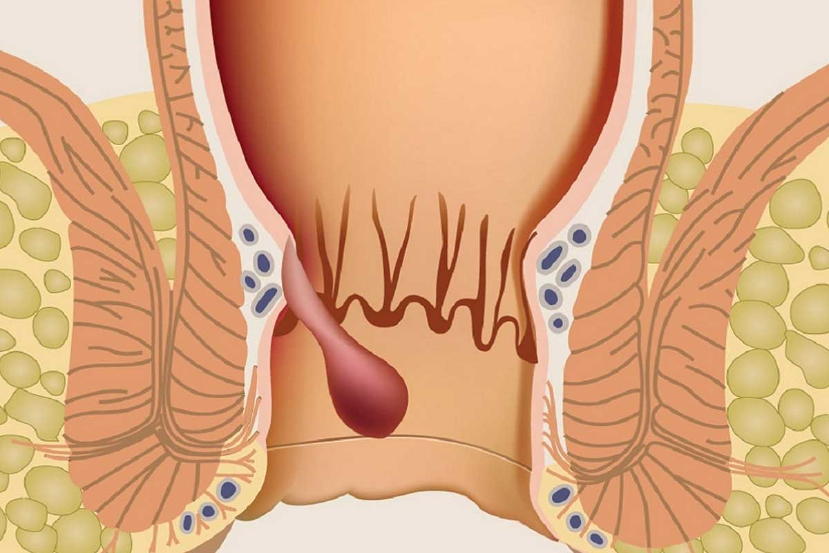 اعراض البواسير الملتهبة