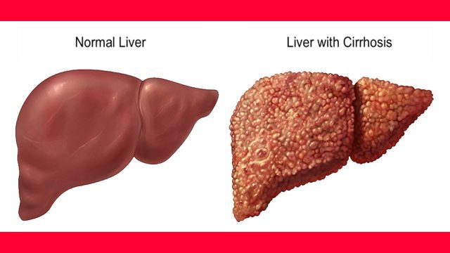 الفرق بين تشمع الكبد وتليف الكبد
