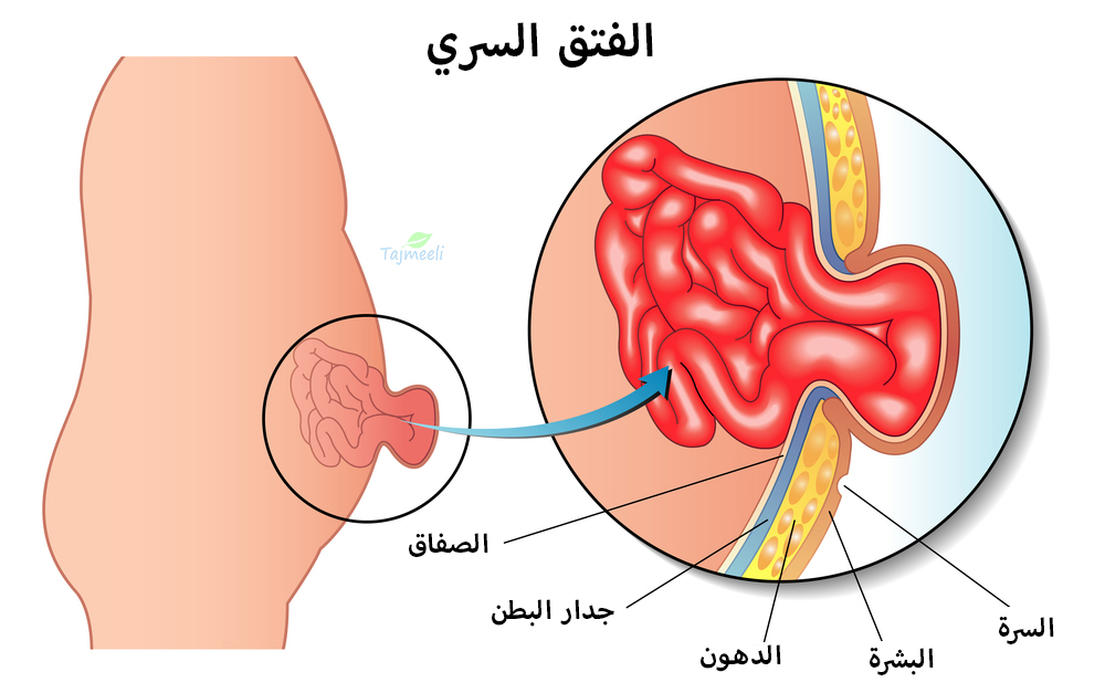 علاج الفتق الأربي بدون جراحة