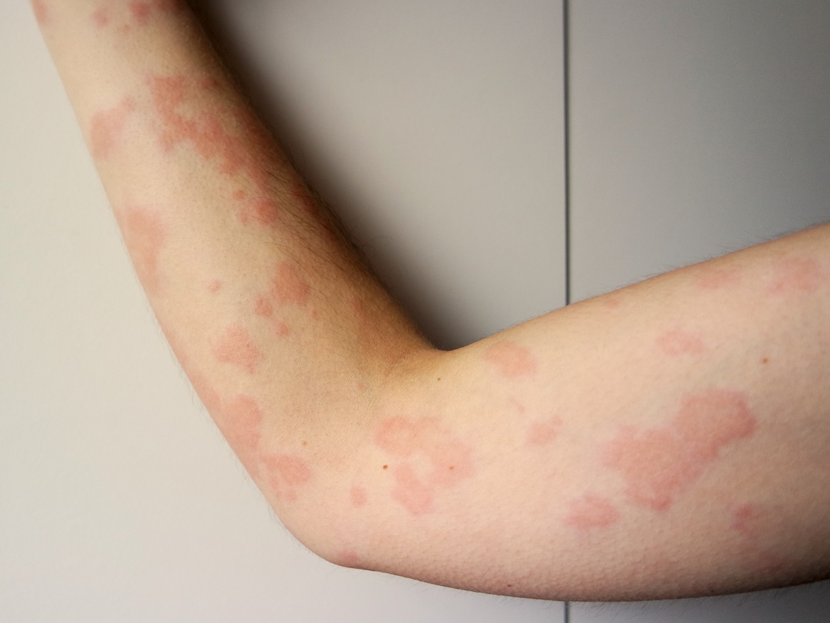 علاج حساسية البيض