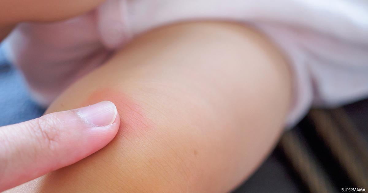 علاج لدغة الحشرات في المنزل