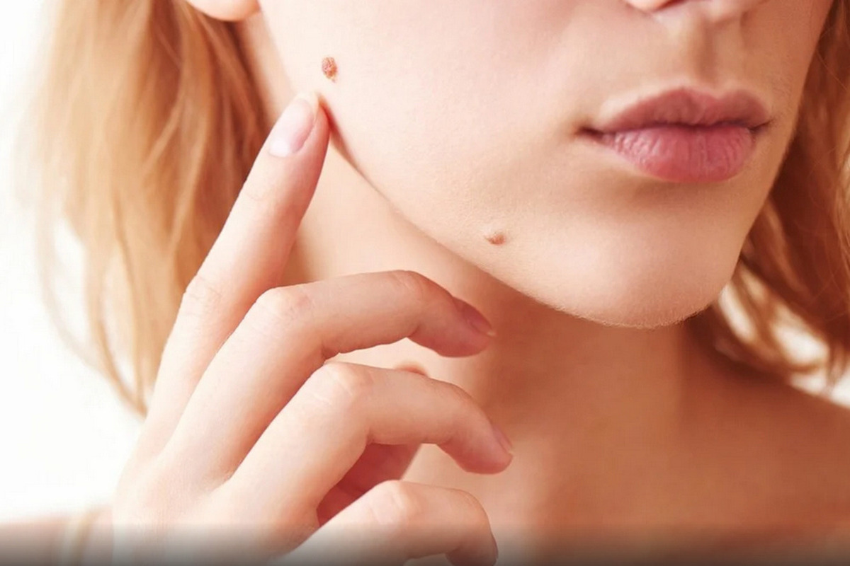 علاج الجلد الزائد بدون طبيب