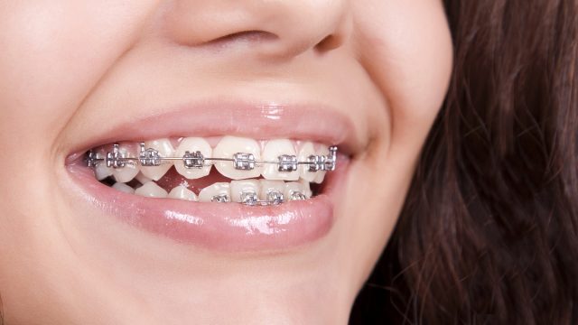 تفسير رؤية تقويم الأسنان في المنام للعزباء - موسوعة