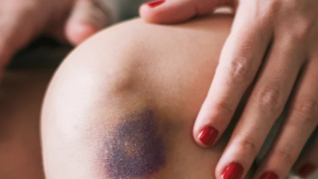 أسماء أفضل مراهم لعلاج الكدمات والتورم وطريقة الإستخدام