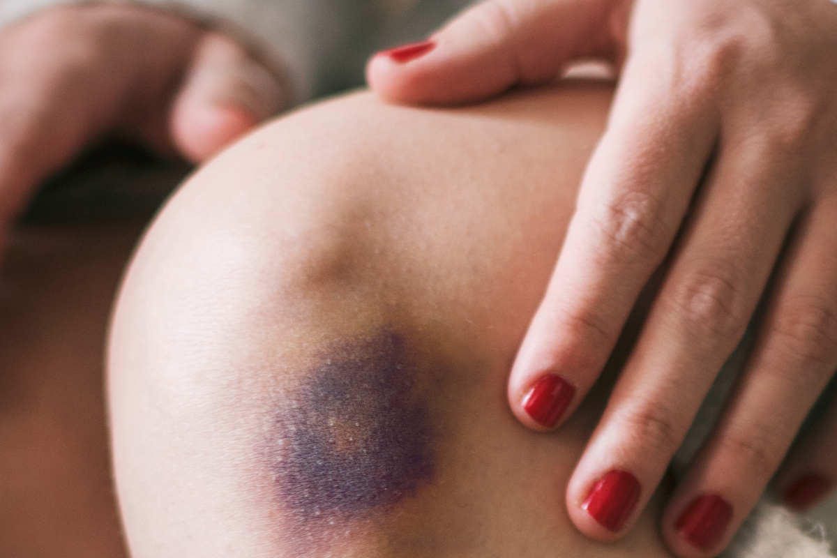 أسماء أفضل مراهم لعلاج الكدمات والتورم وطريقة الإستخدام